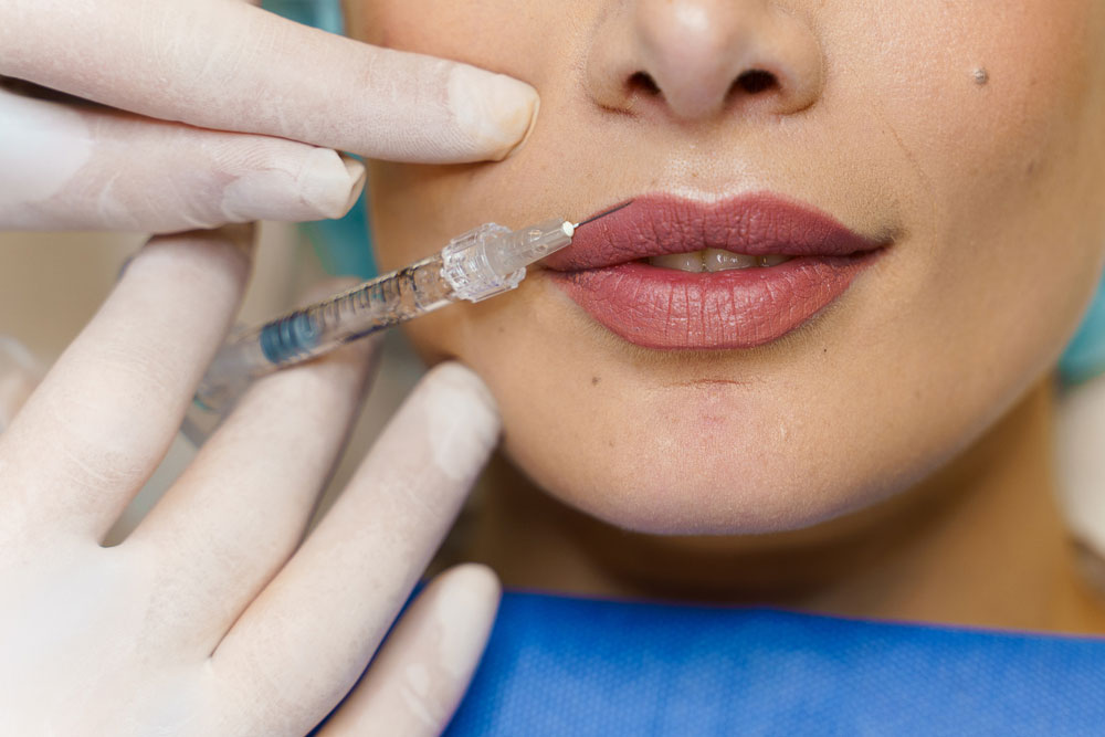 For more information on Russian lip fillers, or to book a consultation contact Ness Aesthetics. Dissolving lips fillers hyaluronic fillers LIP FILLERS