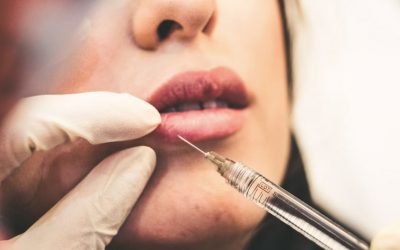 Dissolving Lip Fillers