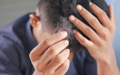 PRP for Hair loss