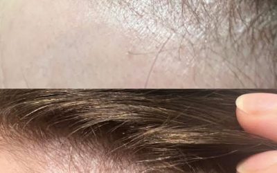 Harnessing the Power of PRP: Treating Hair Loss with Platelet-Rich Plasma