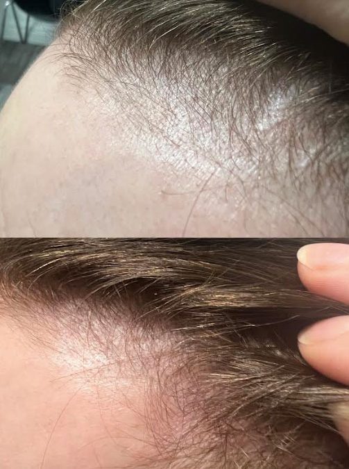 platelet-rich plasma (PRP) therapy. PRP treatment for hair loss has gained popularity due to its natural and effective results. PRP hair loss treatment hair thinning treatment