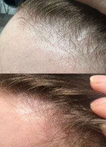 PRP hair loss treatment