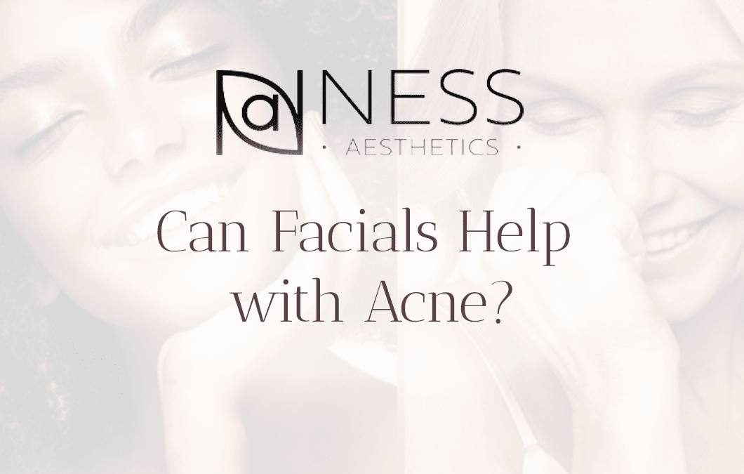 Can Facials Help with Acne?