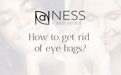 How to get rid of eye bags